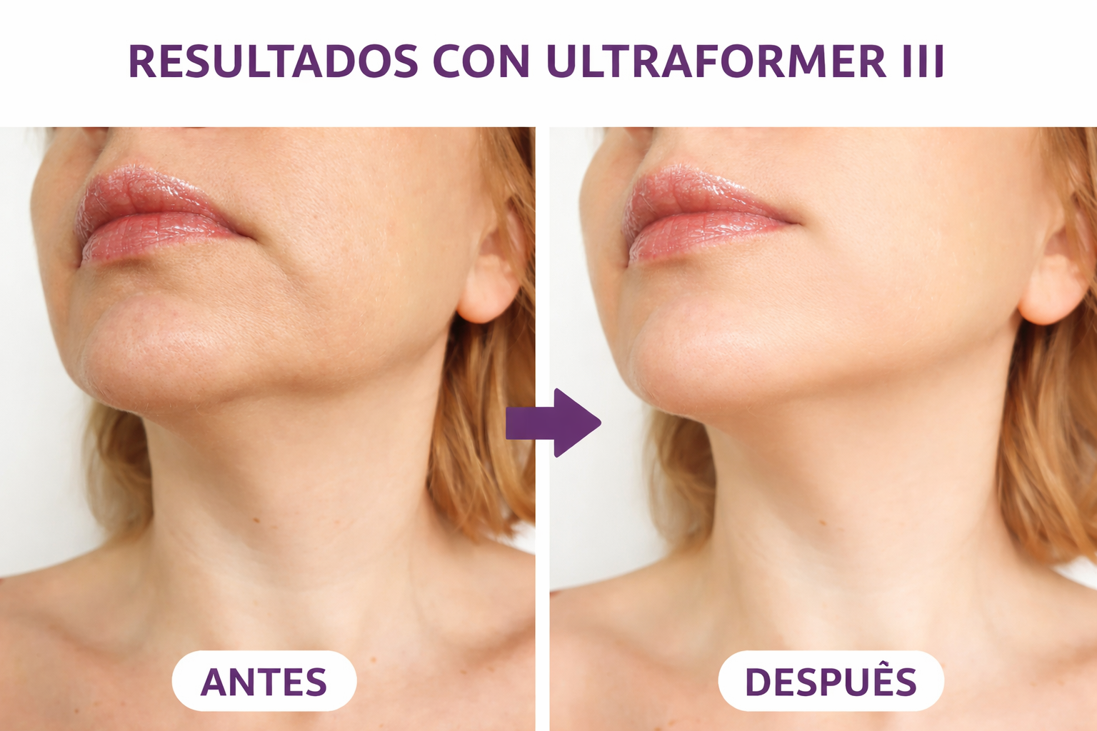 antes y después tratamiento HIFU facial con Ultraformer III mostrando reducción de flacidez y mejora del contorno facial